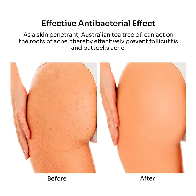 Butt Acne Clearing Treatment Cream (2% Salicylic Acid & Tea Tree Oil)