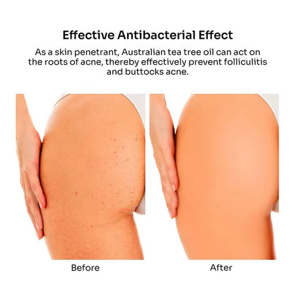Butt Acne Clearing Treatment Cream (2% Salicylic Acid & Tea Tree Oil)